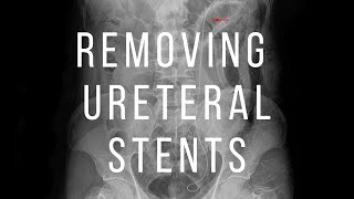 Removing Ureteral Stent in 15 Seconds shorts [upl. by Ewall472]