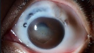 RHEUMATOID ARTHRITS amp EYE SCLERITIS [upl. by Ayokal]