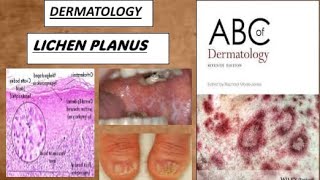 DERMATOLOGY LICHEN PLANUS derma lichenplanus [upl. by Cornelie]