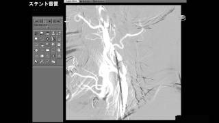 頸動脈ステント留置術 [upl. by Ahk]