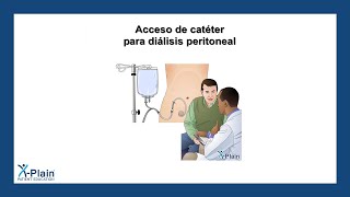 Acceso de catéter para diálisis peritoneal [upl. by Iand]