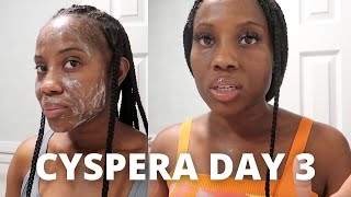 Cyspera Cysteamine Day 3  My Daily Melasma  Hyperpigmentation Skin Care Routine [upl. by Debor]