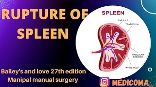 Rupture of spleen  Causes Types of Injuries Clinical Features investigation treatment [upl. by Ahsinert]