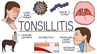 Understanding Tonsillitis [upl. by Mehalek]