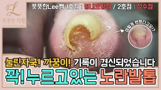 ENG SUB눌린자국 까꿍이 기록경신하셨어요 꽉 누르고있는 노란발톱 관리해볼게요 ingrown toenail  Fresh Foot 풋풋한리쌤 성수점  평내호평점 [upl. by Yud]