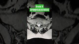 Grade II Anterior Spondylolisthesis of L5 over S1 vertebra viral youtubeshorts mri shortsfeed [upl. by Greiner]