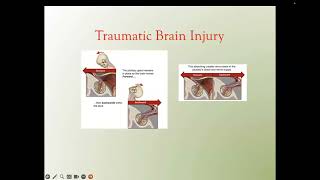 Dr Theodore C Friedmans Webinar on Optimal Replacement for Hypopituitarism and Sheehan’s [upl. by Larimore]