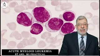 Acute Myeloid Leukemia 07 M3 Practical [upl. by Kciregor]