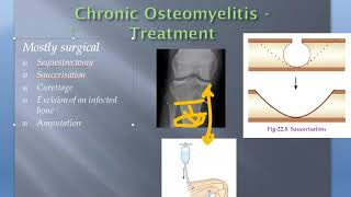 Orthopedics Pyogenic Osteomyelitis Treat Acute Chronic Saucerization [upl. by Aicilet276]