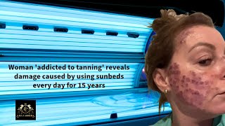 Woman Addicted to Tanning Unveils Sunbed Damage After 15 Years of Daily Use [upl. by Shugart676]