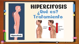 ✅ CIFOSIS e HIPERCIFOSIS dorsal explicación Ejercicios para corregir [upl. by Nnad884]