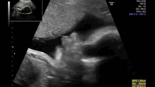 3D 4D ultrasound baby 7 months [upl. by Enorahs]