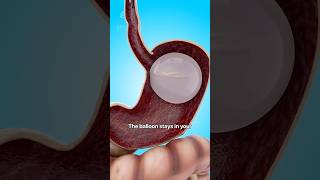 How a Gastric Balloon Helps with Weight Loss 😮  shorts viralvideo  Creativelearning3d [upl. by Tollman]