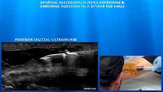 Ultrasound Guided Atypical Olecranon Bursitis Aspiration and Cortisone Injection by probeultrasound [upl. by Nirat982]