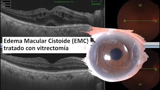 Edema Macular Cistoide EMC  Edema Macular Quístico  Vitrectomía  IrvineGass Syndrome [upl. by Malsi541]