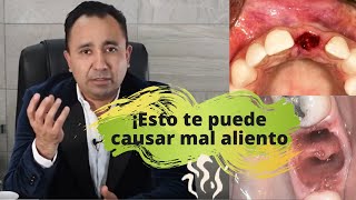 ¿Infección tras extracción dental ¿Qué es la ALVEOLITIS SECA [upl. by Kcirdez66]