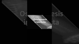 Osteogenesis imperfecta [upl. by Odlauso]