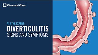 Warning Signs of Diverticulitis  Ask Cleveland Clinics Expert [upl. by Ikilisav]