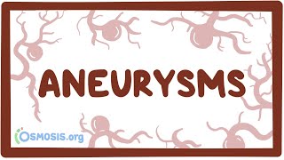 Aneurysms  causes symptoms diagnosis treatment pathology [upl. by Fabriane]