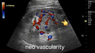 Renal cell carcinoma ultrasound and color Doppler video [upl. by Nylahs]