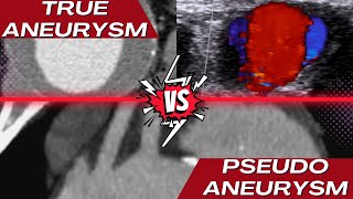 True Aneurysm vs Pseudoaneurysm [upl. by Ansaev]