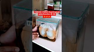 Fibroid uterus  बच्चेदानी की गाँठ । Uterine myoma [upl. by Danella]