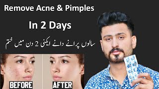 Best Treatment For Remove Pimple amp Acne In 2 Days  Pimples Removal Permanent On Face at Home [upl. by Asnerek]