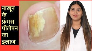 How to cure nail fungus  नाखून का फ़ंगस इन्फ़ेक्शन  Onycomycosis Treatment in Hindi [upl. by Lemuelah]