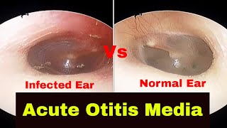 Acute Otitis Media  Diagnosis and Treatment [upl. by Broek368]