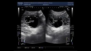 Ultrasound Video showing the Traumatic injury of Spleen [upl. by Airdnat627]