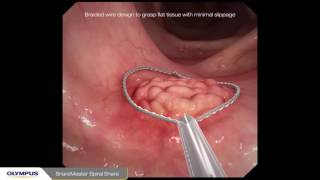 Endoscopic Mycosal Resection EMR procedure overview of a sessile polyp using Olympus devices [upl. by Yereffej]