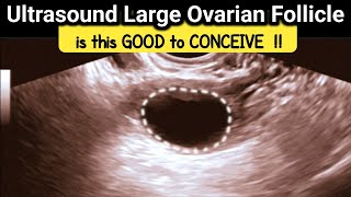 what is Large Ovarian Follicle  is it GOOD to CONCEIVE  TVS Ultrasound [upl. by Dde399]