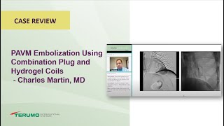 PAVM Embolization Using Combination Plug and Hydrogel Coils  Charles Martin MD  Terumo Interventi [upl. by Yniatirb656]