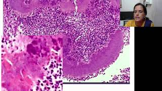 Actinomycosis aetiologyclinical manifestationsgross and microscopy [upl. by Nelly]