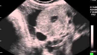 Bovine Ovary CL Corpus Luteum filling in and follicles  ultrasound [upl. by Vincenz]