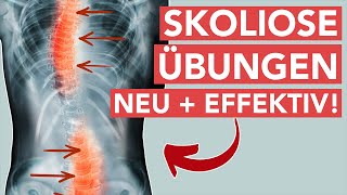 Skoliose übungen  Neue effektive Behandlungsmethode [upl. by Natanoy365]