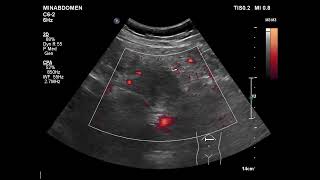 unmatching sono amp CT on pancreas [upl. by Gusti637]