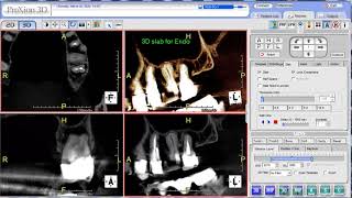 PreXion Training Tips 3D Slab for Endo [upl. by Lizette]