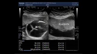 Fetal Hydrocephalus with Pregnancy of about 19 weeks [upl. by Aiclef]