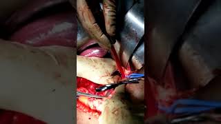 Radical Nephrectomy with IVC thrombectomy [upl. by Wurster919]