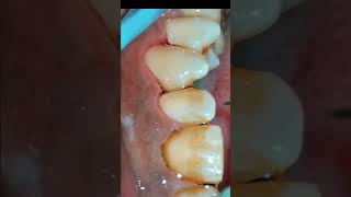 Scaling and Air Polishing using Prophymate teeth teethcleaning teethwhitening [upl. by Yrebmik123]