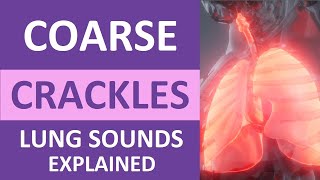 Coarse Crackles Lung Sounds Audio Causes Auscultation Nursing NCLEX Review [upl. by Yrtneg]