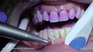 PROPHYLAXIS  Dr Giacomo Oldoini  Periodontal Mantainance [upl. by Ilsa]