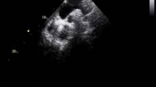 coarctation of the aorta and RHDmild mitral stenosis [upl. by Deste]