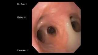 Veterinary Bronchoscopy457 Diffuse Bronchiectasis Chronic cough Labrador Retriever 5y M [upl. by Velma174]