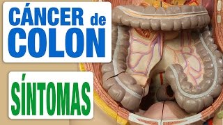 Cáncer de Colon  Síntomas [upl. by Amato578]