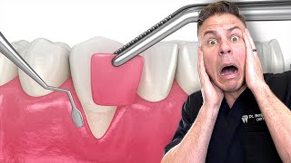 Dentist Reveals What REALLY Happens In A Gum Graft [upl. by Bryn683]