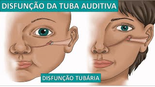 Disfunção da Tuba Auditiva  Disfunção Tubária [upl. by Migeon]