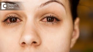 5 Causes of Eye Twich  Dr Sriram Ramalingam [upl. by Baese]