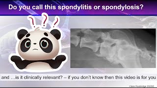 Bony spurs between the vertebrae  is is spondylosis spondylitis discospondylitis or DISH [upl. by Potts467]